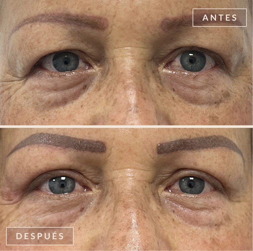 antes y después blefaroplastia Bogotá Dra. Liz Pava