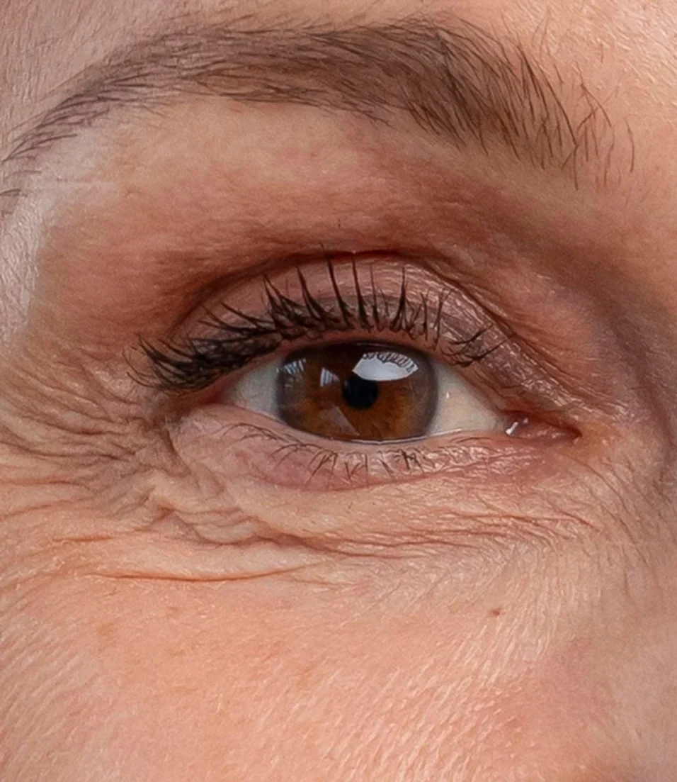 blefaroplastia en Bogotá cirugía de párpados Dra. Liz Pava