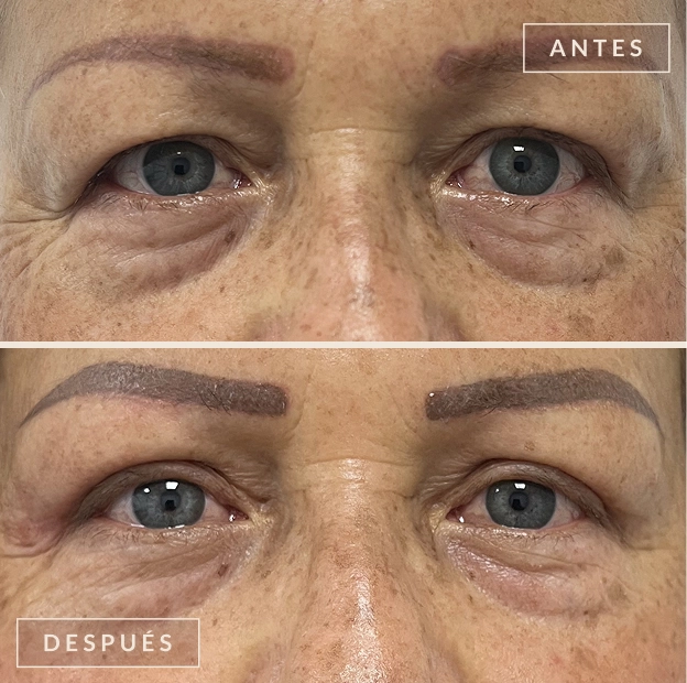 Antes y después blefaroplastia Bogotá - Dra. Liz Pava cirujana plástica