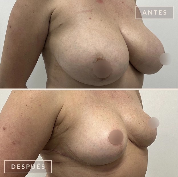 Antes y después mamoplastia de reducción Bogotá - Dra. Liz Pava cirujana plástica