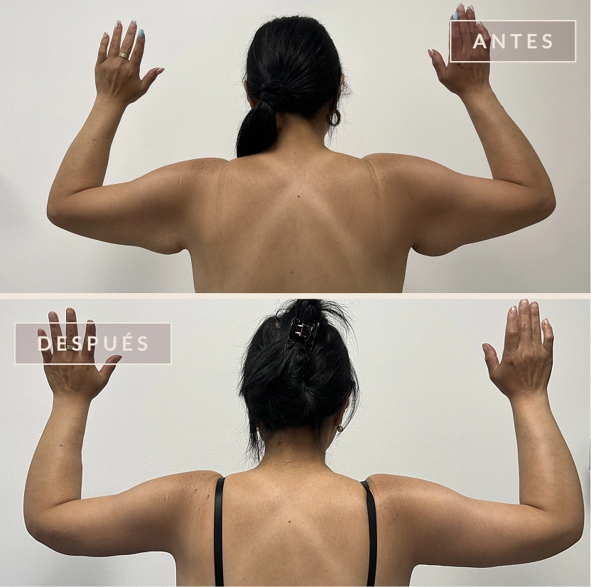 BRAQUIOPLASTIA ANTES DESPUES 1
