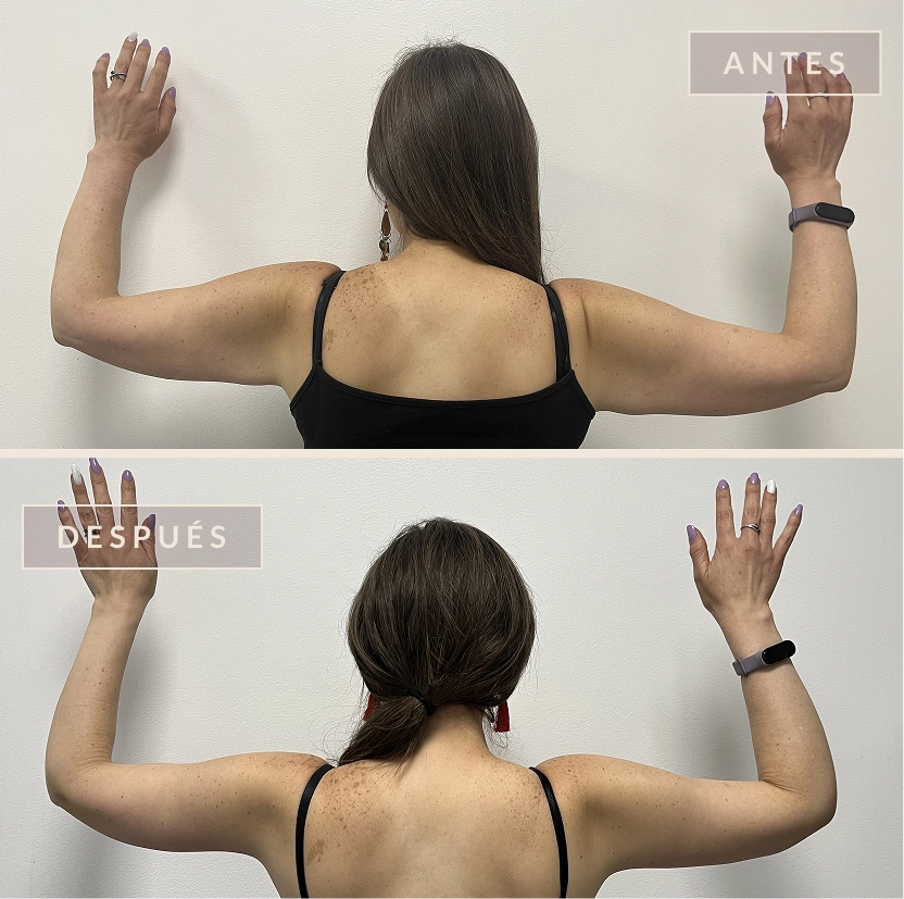 CASO BRAQUIOPLASTIA ANTES DESPUES
