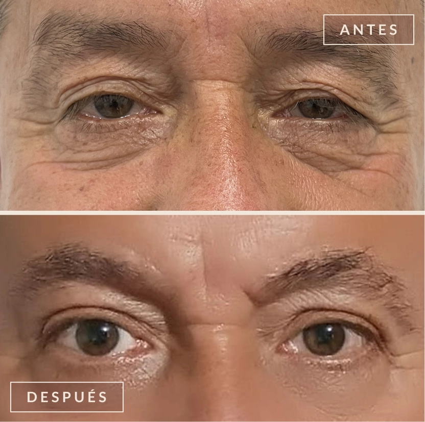 antes y después elevación de cejas blefaroplastia Bogotá Dra. Liz Pava