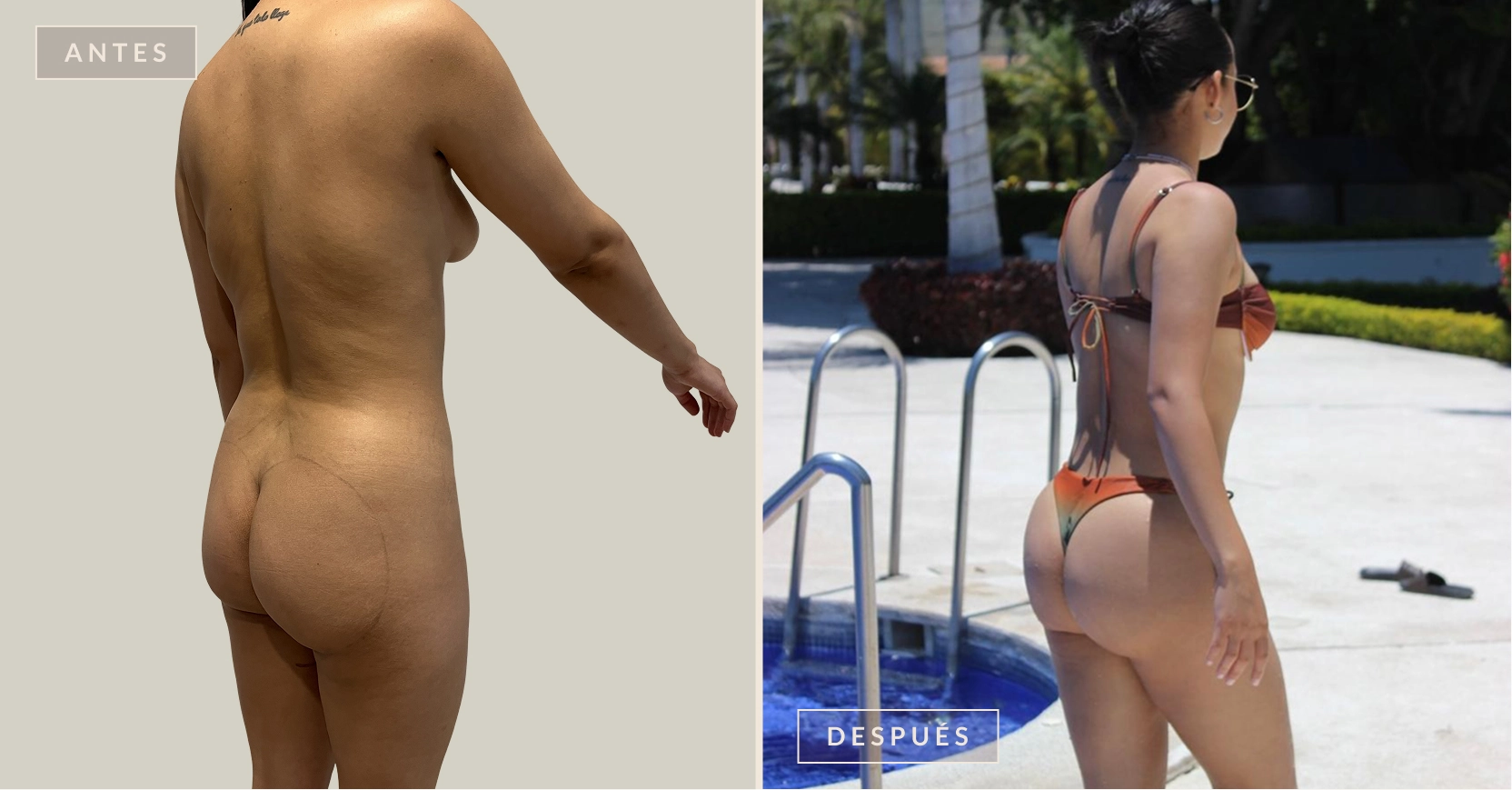 lipotransferencia glútea 2 antes y después lipotransferencia glútea Bogotá Dra. Liz Pava
