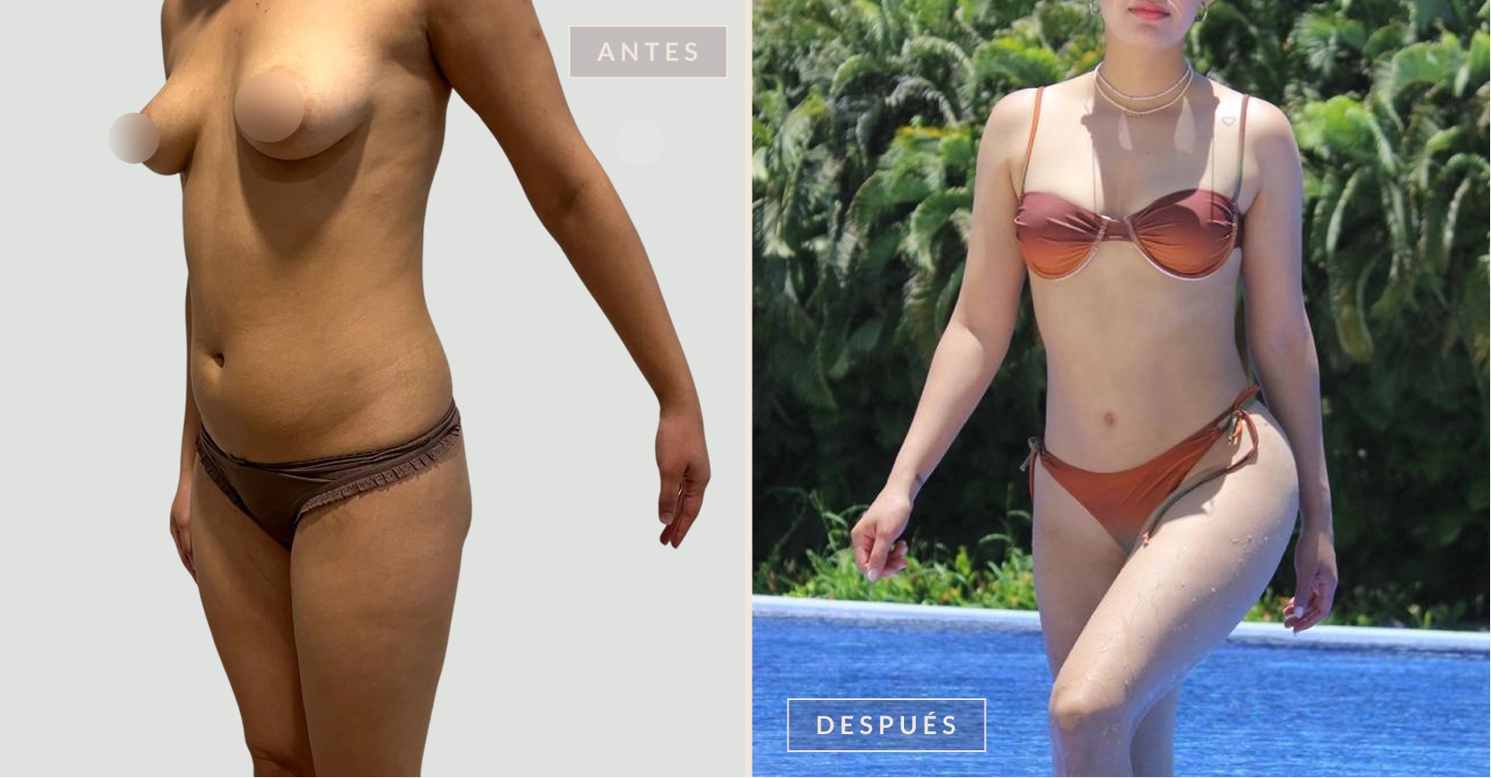 antes y después lipoescultura Bogotá Dra. Liz Pava