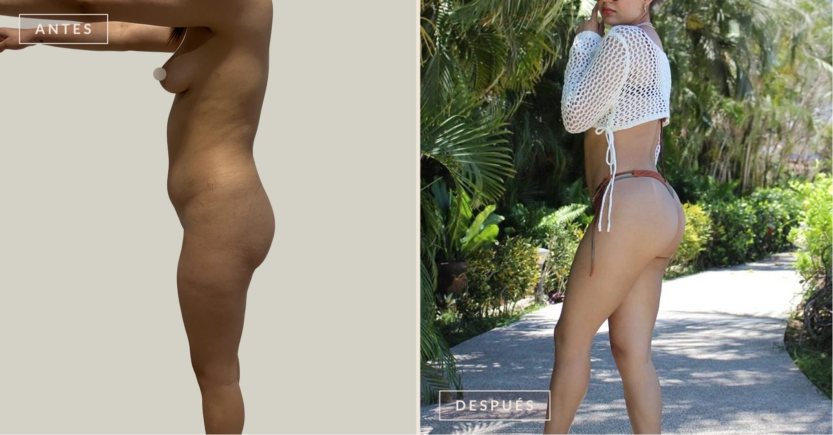 lipotransferencia glútea 1 antes y después lipotransferencia glútea Bogotá Dra. Liz Pava