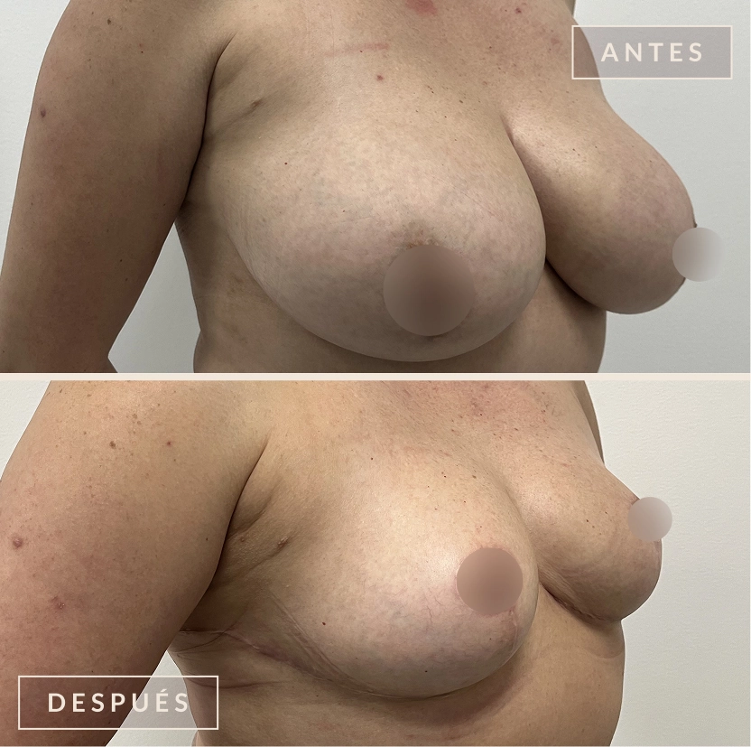 antes y después mamoplastia reducción levantamiento senos Bogotá Dra. Liz Pava