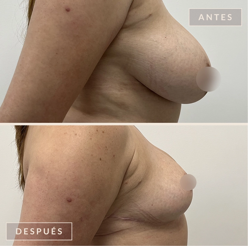 antes y después mamoplastia reducción levantamiento senos Bogotá Dra. Liz Pava