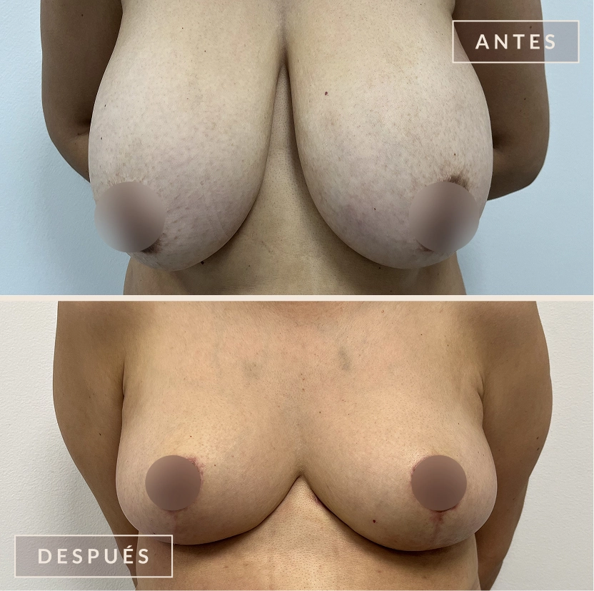 antes y después mamoplastia reducción levantamiento senos Bogotá Dra. Liz Pava
