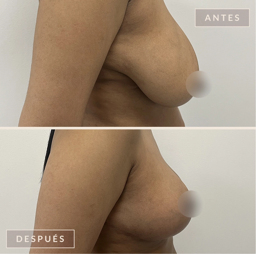 antes y después mamoplastia reducción levantamiento senos Bogotá Dra. Liz Pava