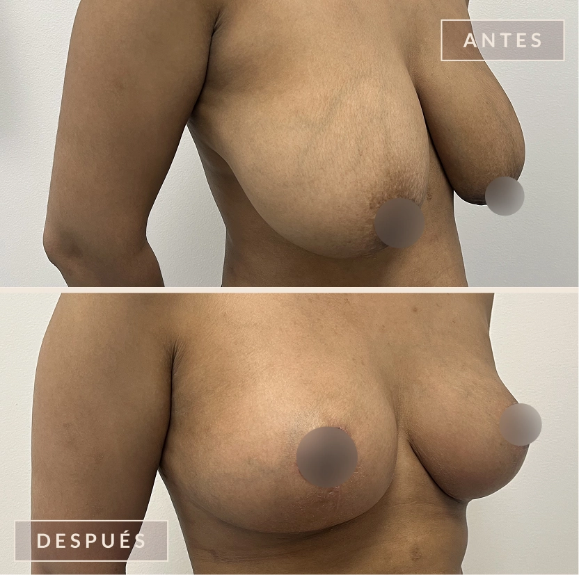 antes y después mamoplastia reducción levantamiento senos Bogotá Dra. Liz Pava