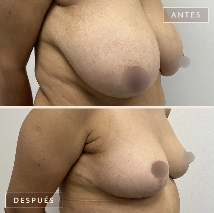 antes y después mamoplastia reducción levantamiento senos Bogotá Dra. Liz Pava