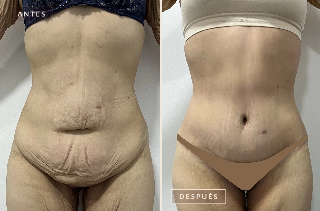 antes y después cirugía posbariátrica Bogotá Dra. Liz Pava
