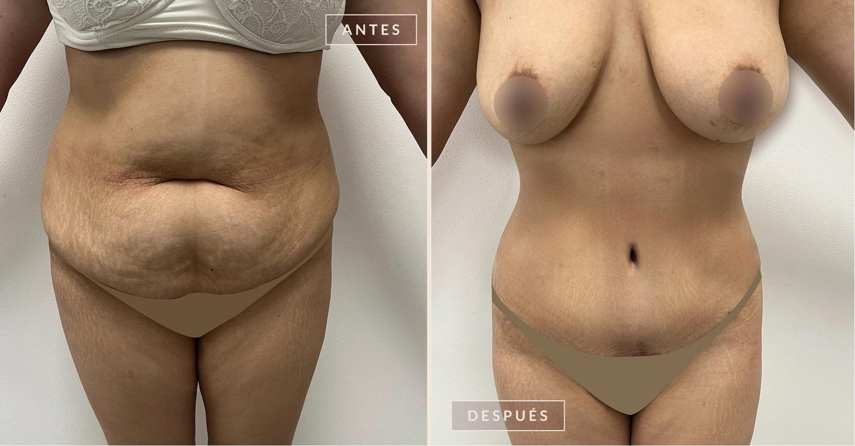 antes y después abdominoplastia Bogotá Dra. Liz Pava