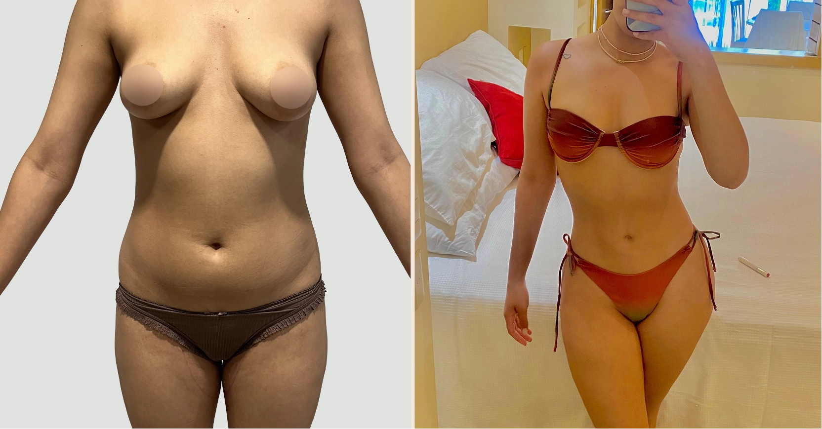 antes y después lipoescultura Bogotá Dra. Liz Pava