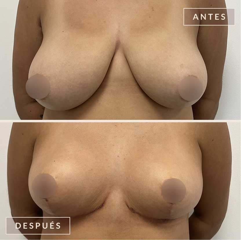 antes y después mamoplastia reducción levantamiento senos Bogotá Dra. Liz Pava