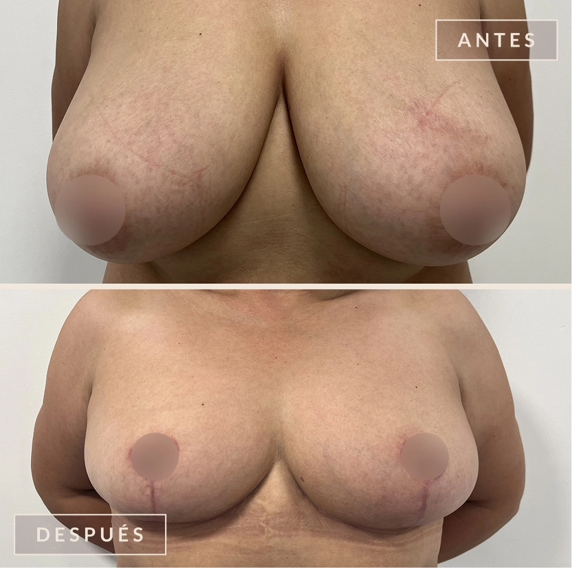 antes y después mamoplastia reducción levantamiento senos Bogotá Dra. Liz Pava