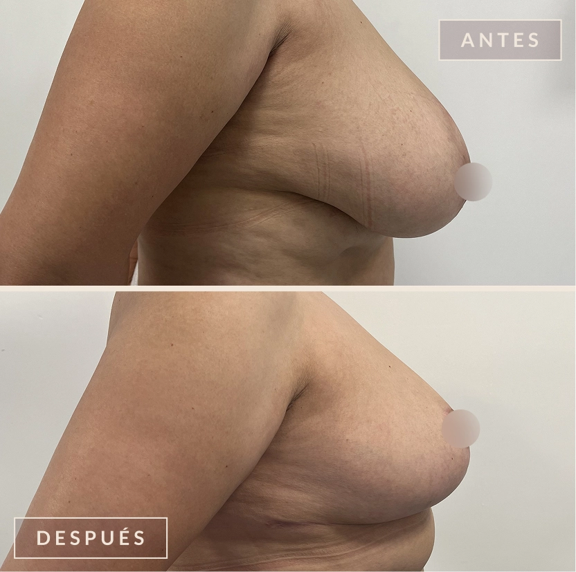 antes y después mamoplastia reducción levantamiento senos Bogotá Dra. Liz Pava