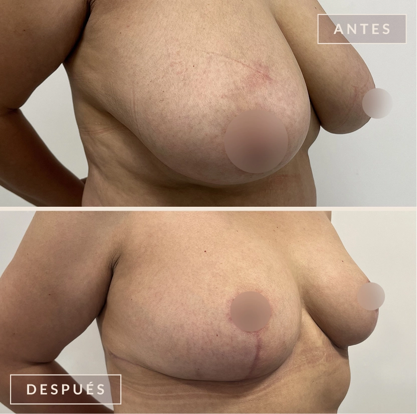 antes y después mamoplastia reducción levantamiento senos Bogotá Dra. Liz Pava