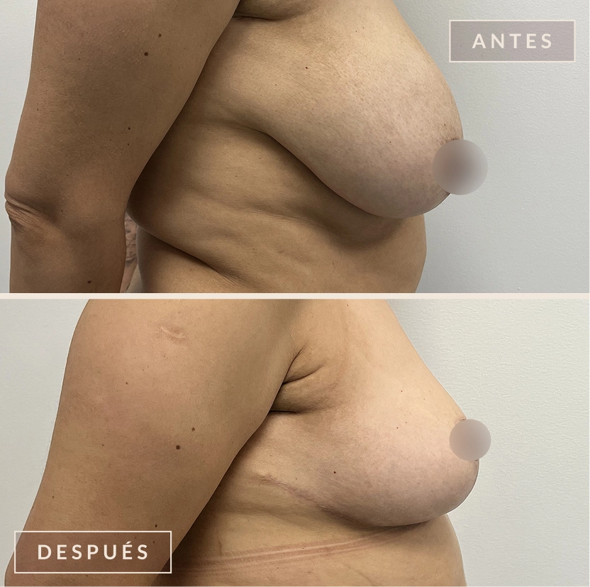 antes y después mamoplastia reducción levantamiento senos Bogotá Dra. Liz Pava