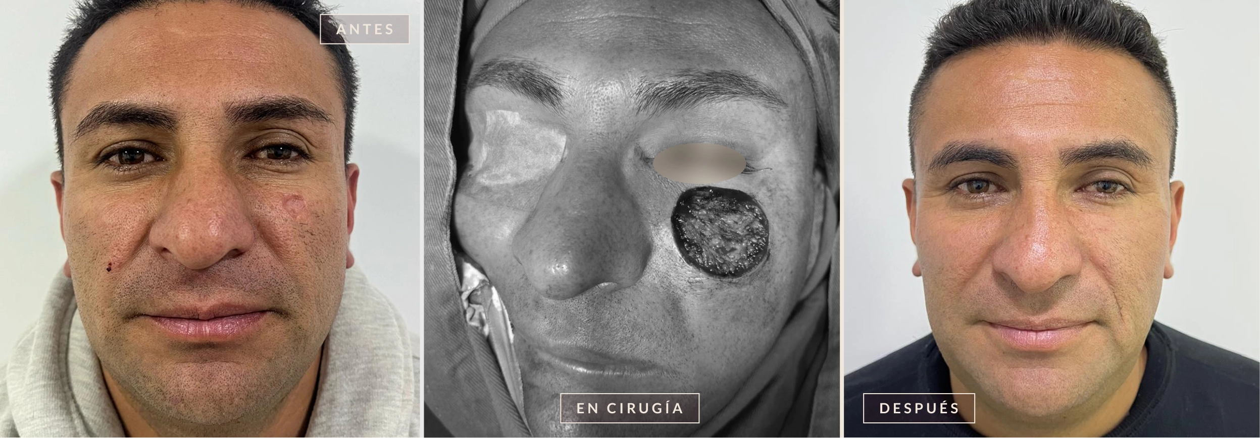 antes y después cirugía reconstructiva Bogotá Dra. Liz Pava