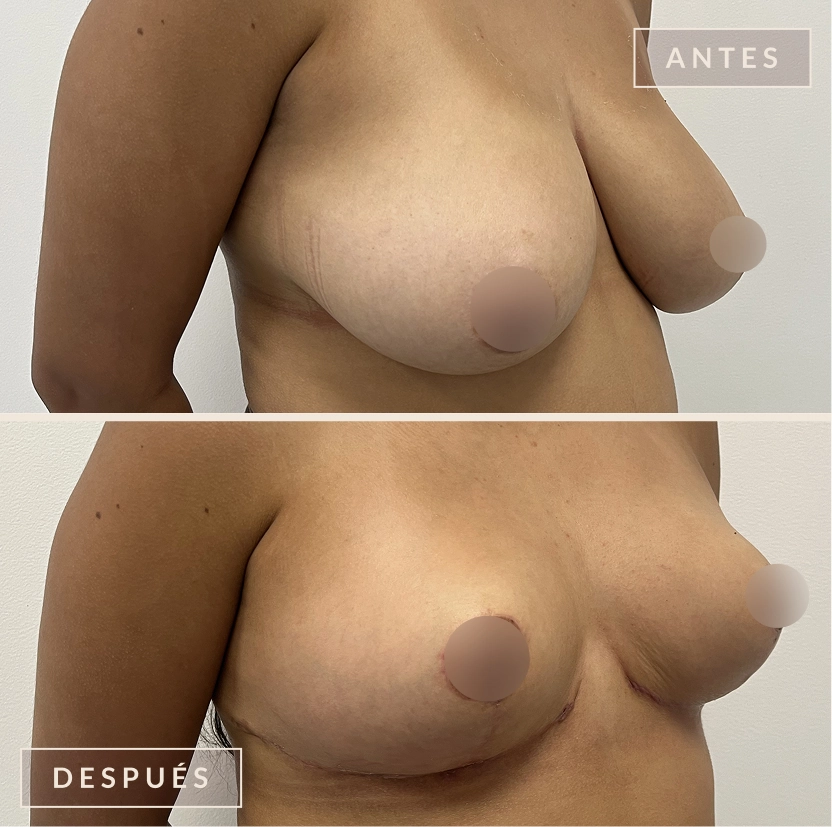 antes y después mamoplastia reducción levantamiento senos Bogotá Dra. Liz Pava